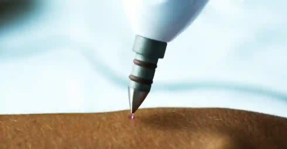 Rejuvenescimento sem cirurgia com técnica de Jato de Plasma